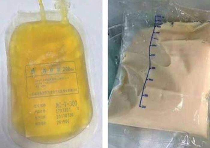 Kondisi darah L yang berubah warna menjadi kuning