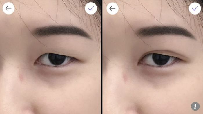 Ilustrasi operasi kelopak mata ganda.