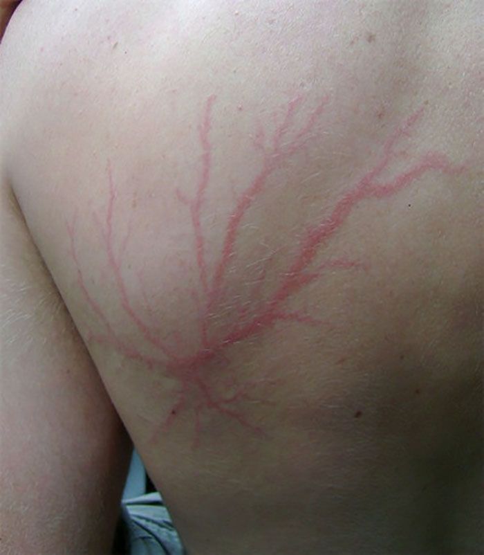 Contoh ‘Lichtenberg’.