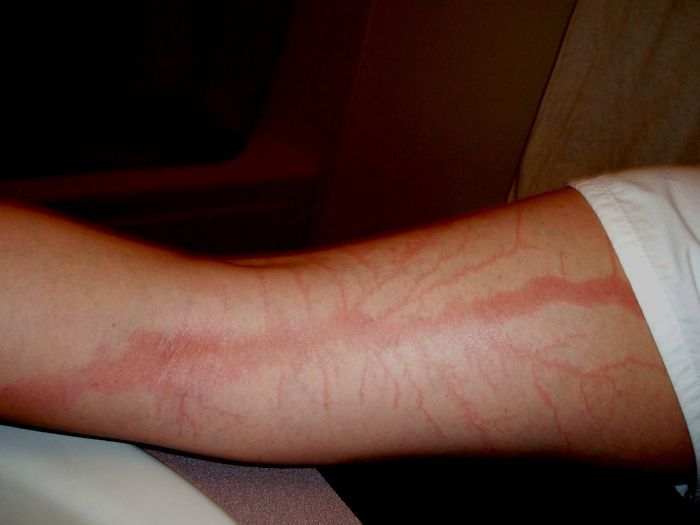 Contoh ‘Lichtenberg’.