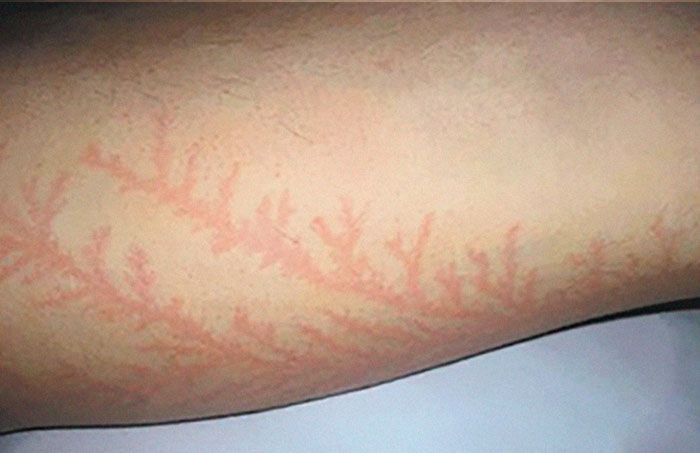 Contoh ‘Lichtenberg’.