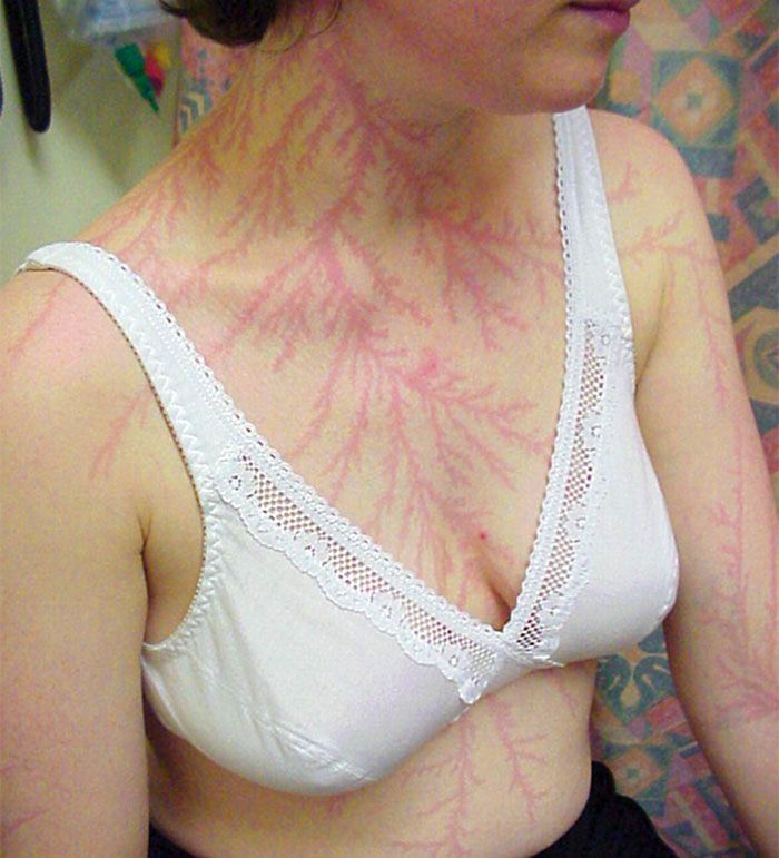 Contoh ‘Lichtenberg’.