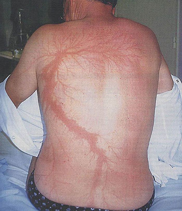 Contoh ‘Lichtenberg’.