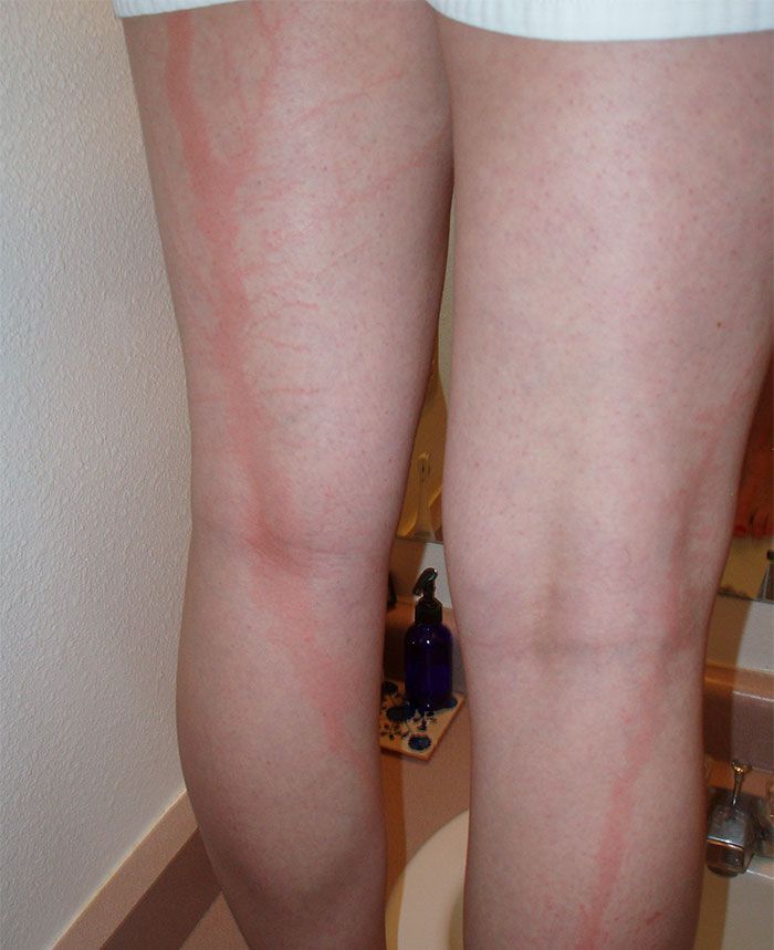 Contoh ‘Lichtenberg’.