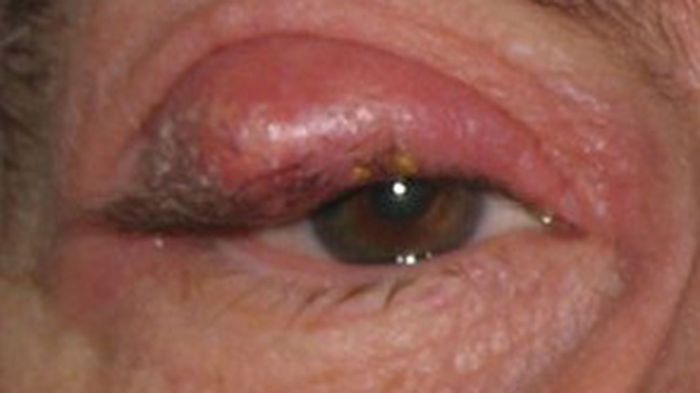 Kista Chalazion