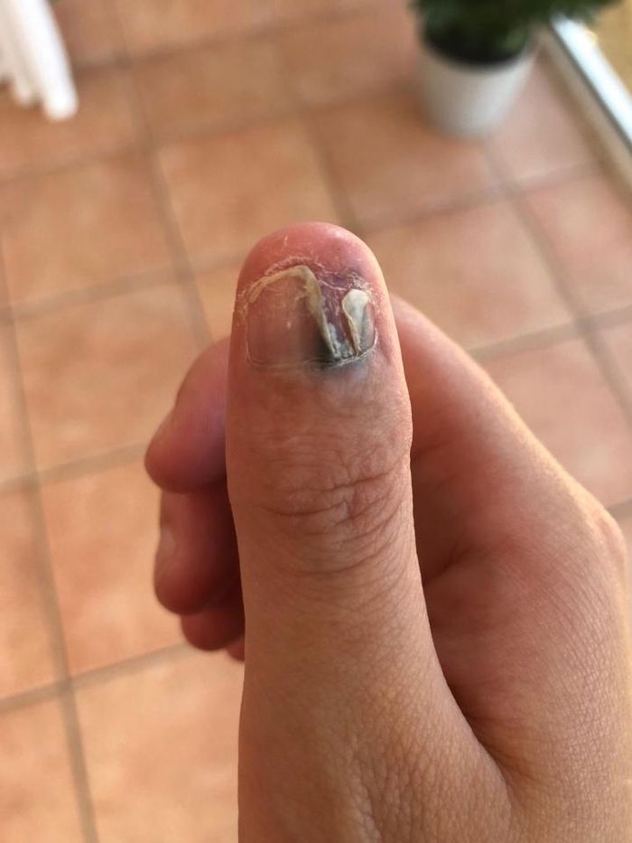 ibu jari Courtey menghitam dan harus diamputasi
