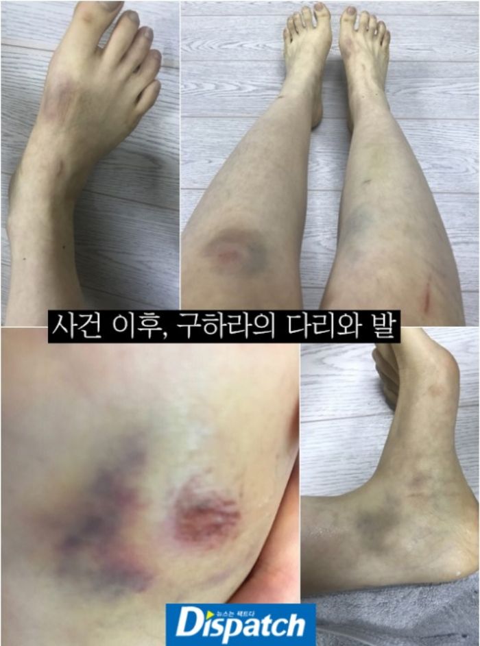 Goo Hara memar