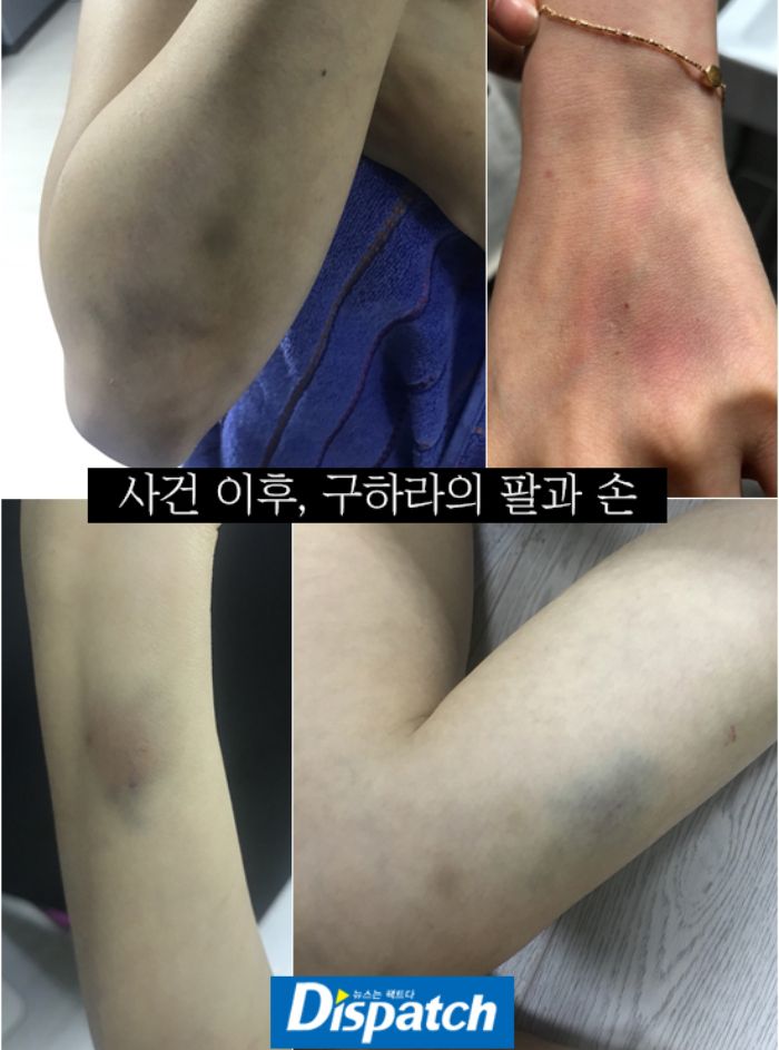 Memar yang diterima Goo Hara 