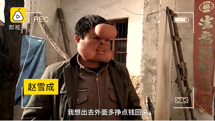 Zhao sebelum dioperasi