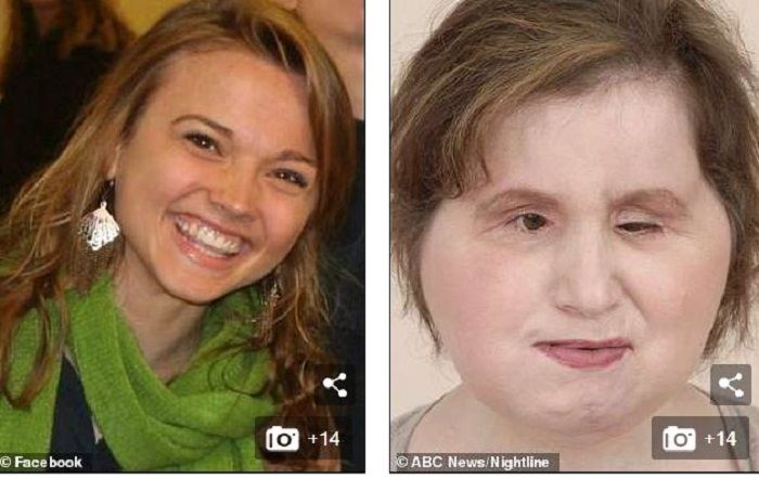 dailymail
Katie Stubblefield sebelum dan sesudah tranplantasi wajah.