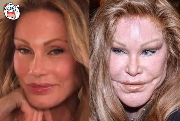 Jocelyn Wildenstein sebelum operasi plastik (kiri), sesudah operasi plastik (kanan)
