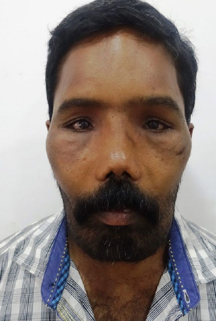 Michael Havis
Suresh setelah dioperasi