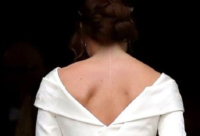 Bekas luka saat Putri Eugenie dioperasi