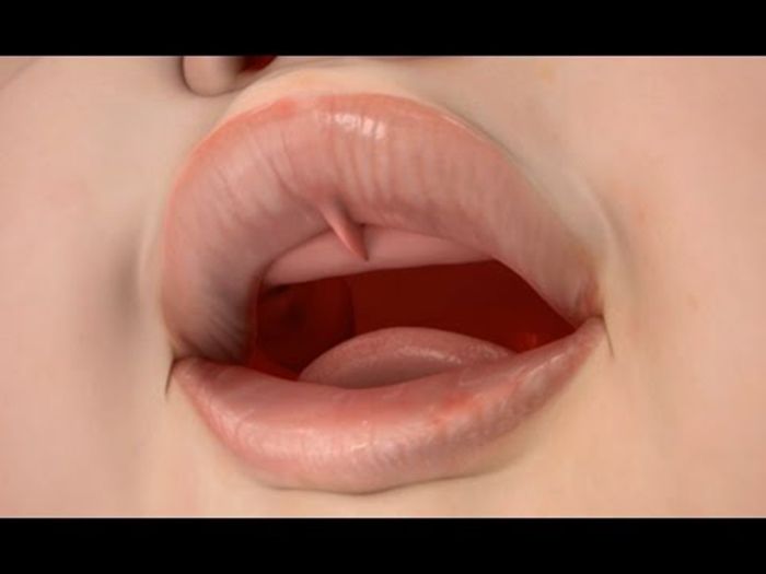 Lip Tie