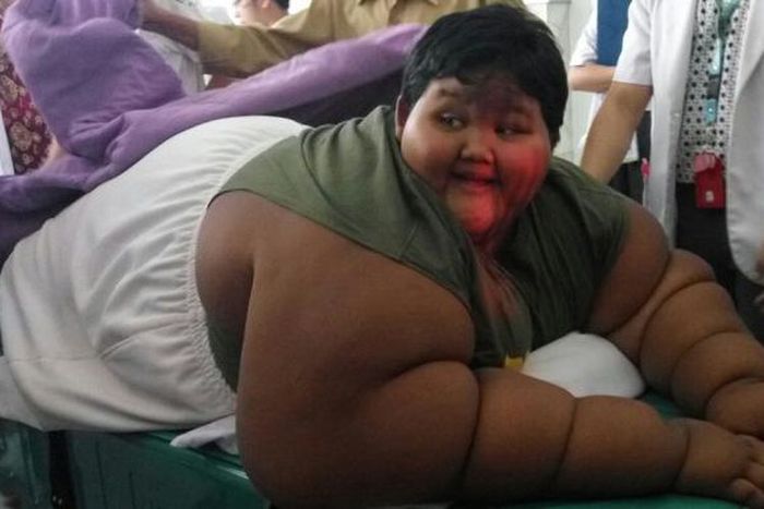 3 Cara Bocah Obesitas, Arya Permana, Turunkan Berat Badannya Sampai 102 Kg