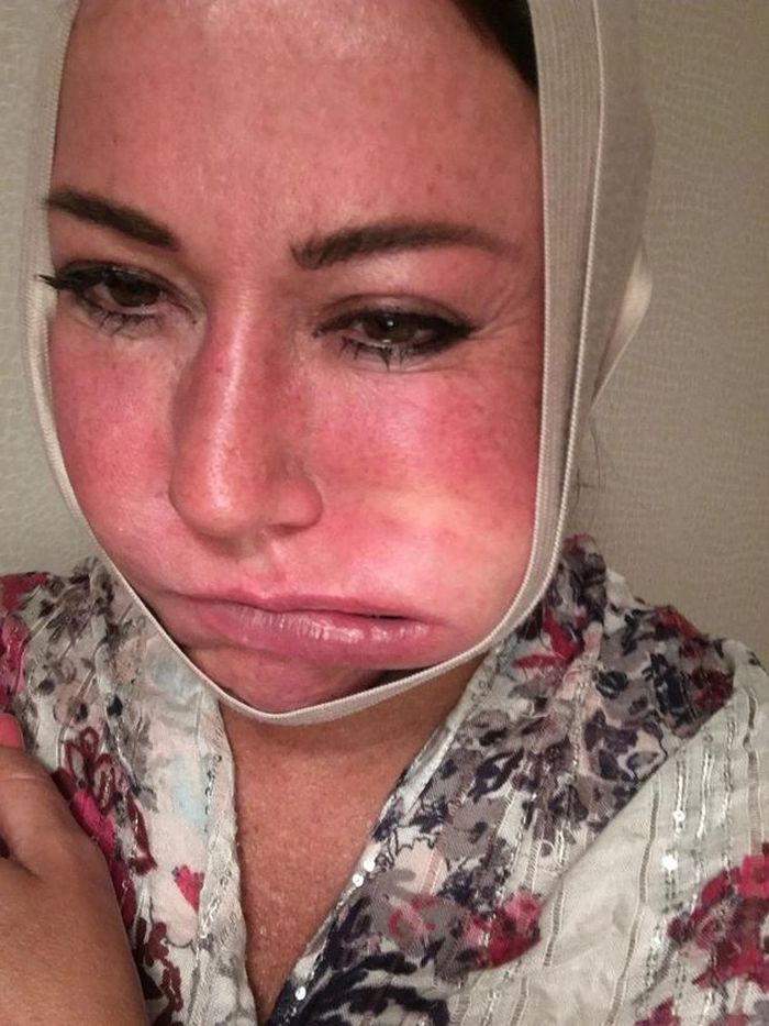 Mulut Lisa Appleton yang membengkak setelah operasi wajah