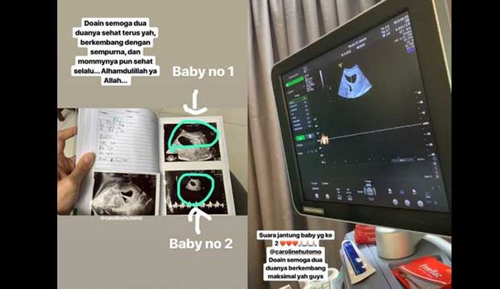 Ratna Galih umumkan kehamilan anak kembar.