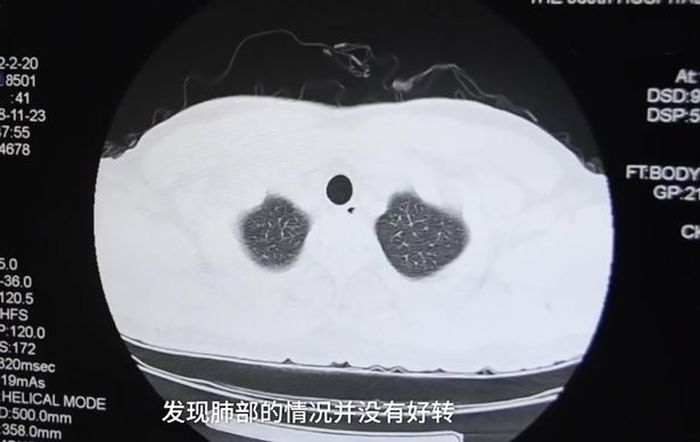Jamur yang terlihat berdasarkan scan X-Ray