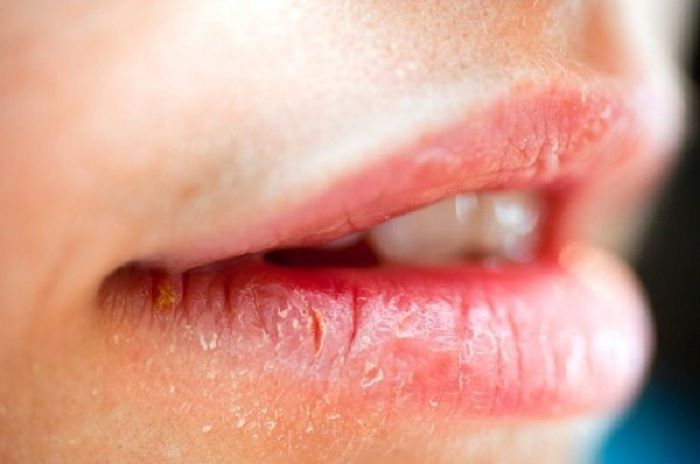 Bibir pecah-pecah