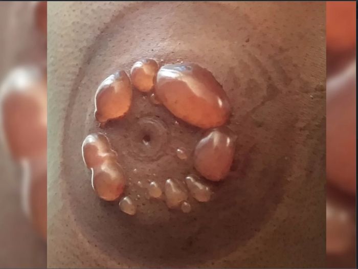 Akibat terapi bekam.