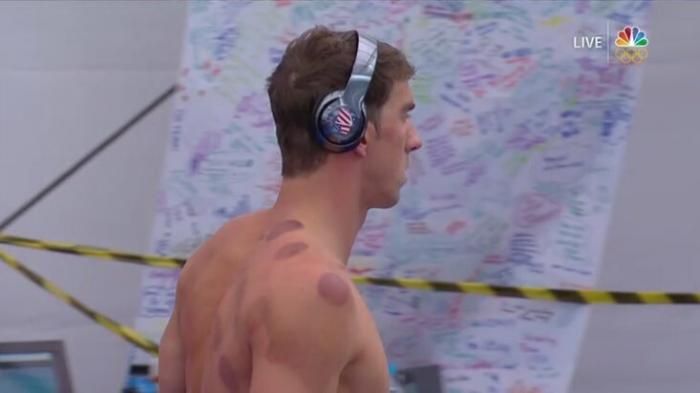 Michael Phelps lakukan terapi bekam.