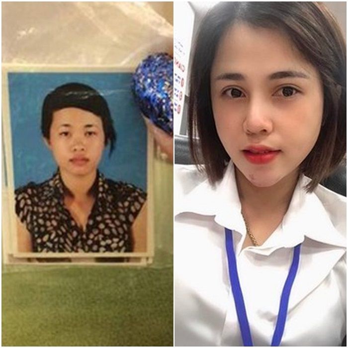 Perubahan perempuan Vietnam sebelum dan sesudah operasi plastik