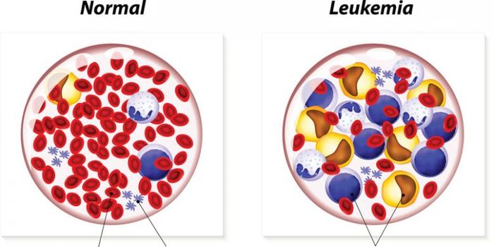 Ilustrasi leukemia