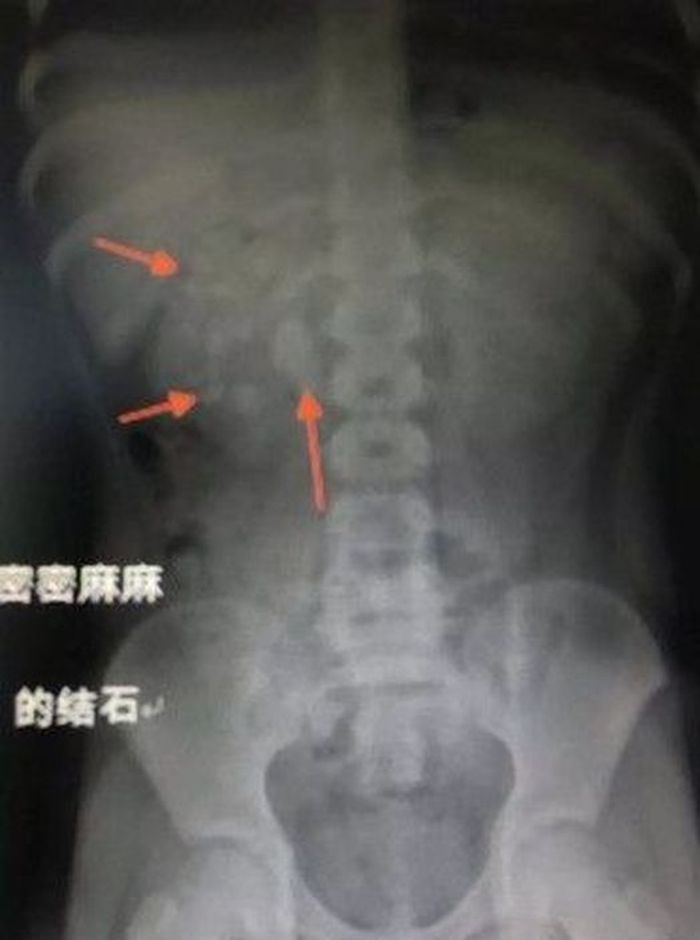 Hasil scan yang menunjukkan batu di ginjal anak ini
