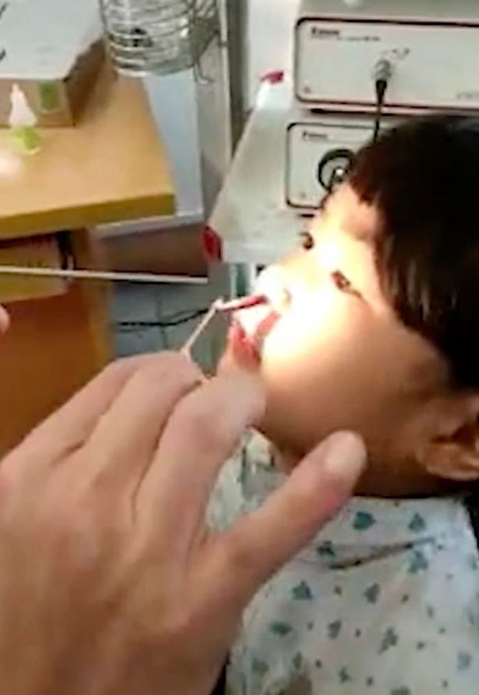 Cacing tumbuh di dalam <a href='https://pontianak.tribunnews.com/tag/hidung' title='hidung'>hidung</a>