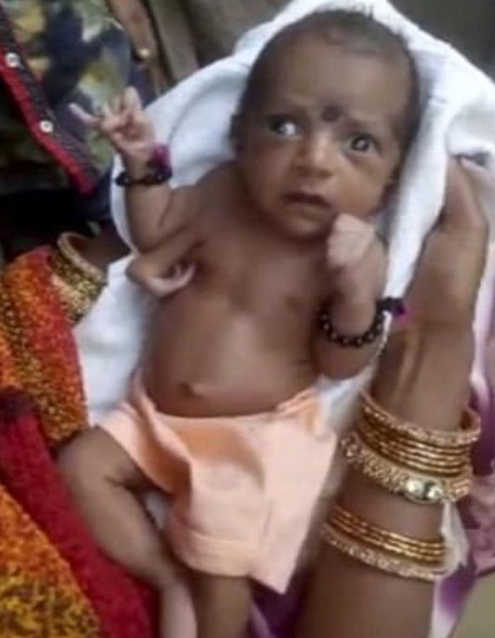 Bayi dengan tiga tangan