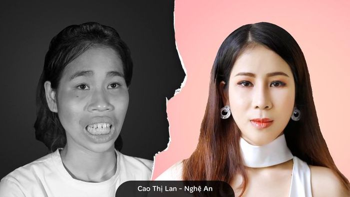 Sebelum dan sesudah melakukan operasi plastik