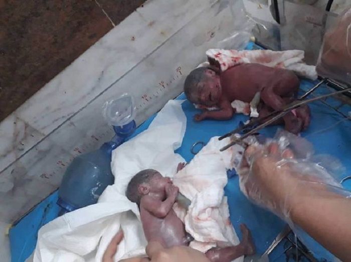 Bayi kembar 7 di Irak