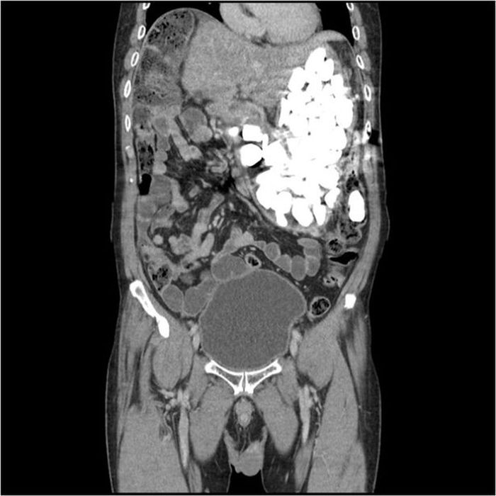 Hasil scan menunjukkan sejumlah batu dalam perut Pasien.
