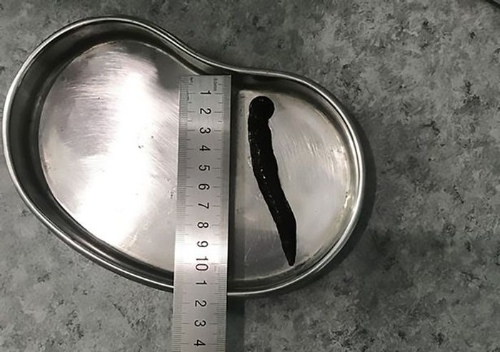 Lintah sepanjang 10 cm yang bersarang di tenggorokan pasien