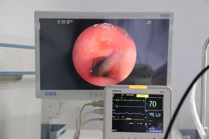 Dengan endoskopi, dokter menemukan lintah di tenggorokan pasien