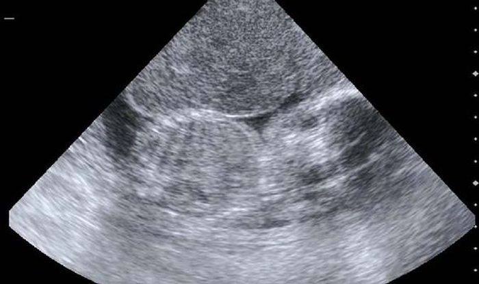 Express
Rekaman ultrasound dari jani sang ibu.