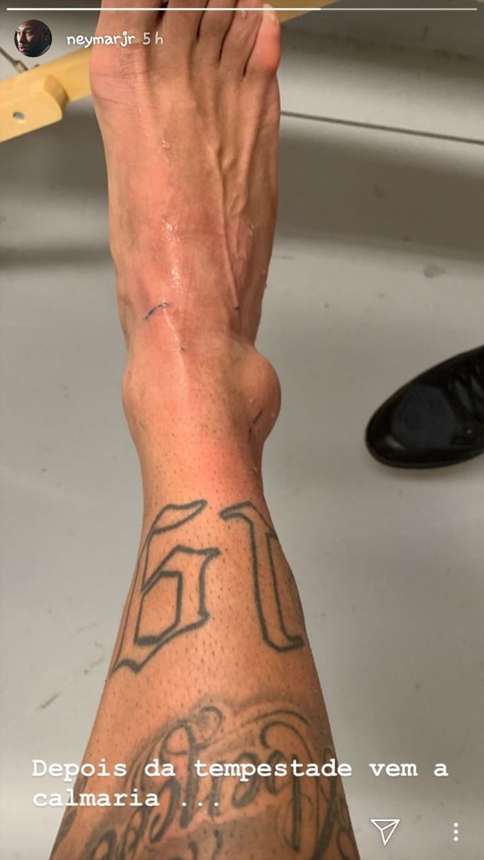 Unggahan Neymar di instagram pada Jumat (7/6/2019) memperlihatkan kondisi engkelnya yang cedera.