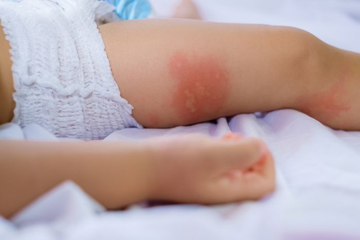 Ilustrasi ruam kulit pada bayi yang disebabkan oleh alergi susu sapi.