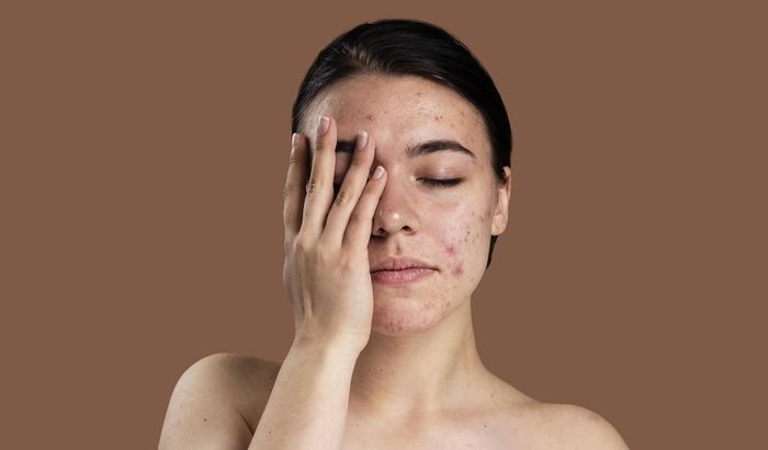 Kandungan Skincare untuk Jerawat Ini Bisa Bikin Kulit Kering