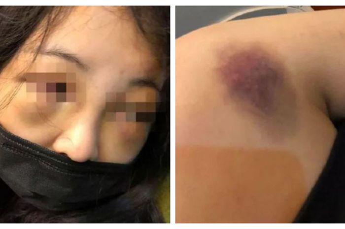 Seorang gadis dianiaya gara-gara mendengkur keras