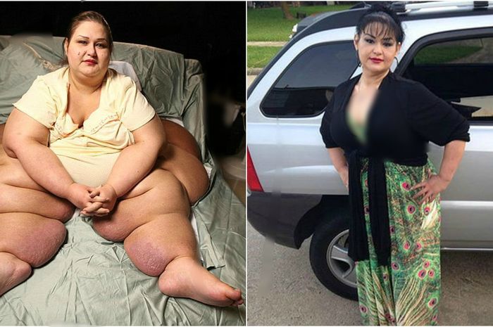Perubahan Mayra Rosales setelah 11 kali sedot lemak