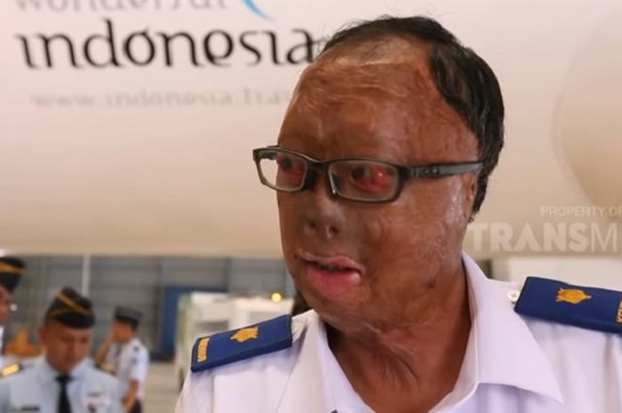 Kisah Kapten Sigit, Pilot yang Pernah Terbakar di Pesawat dan Tetap Semangat Bekerja di Penerbangan
