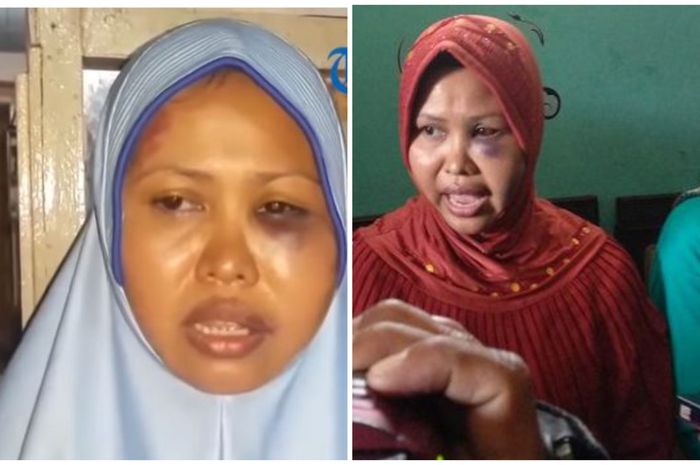 Nur Azizah salah satu kader jumantik yang mendapatkan luka cukup parah.