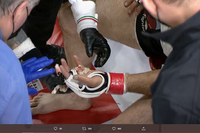 Kondisi jari petarung MMA asal Kanada, Khetag Pliev yang hilang di laga CFFC 94, Kamis (1/4/2021).