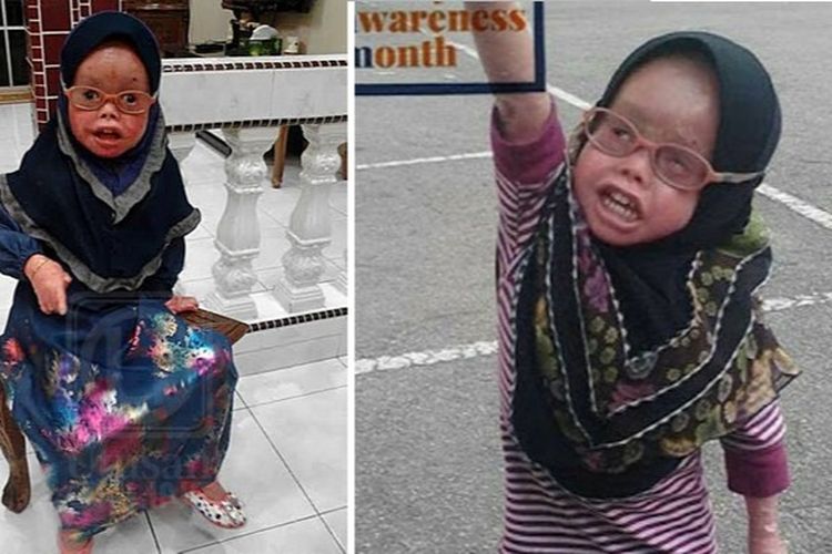Berita Ichthyosis Harlequin Terbaru Hari Ini - Grid.ID
