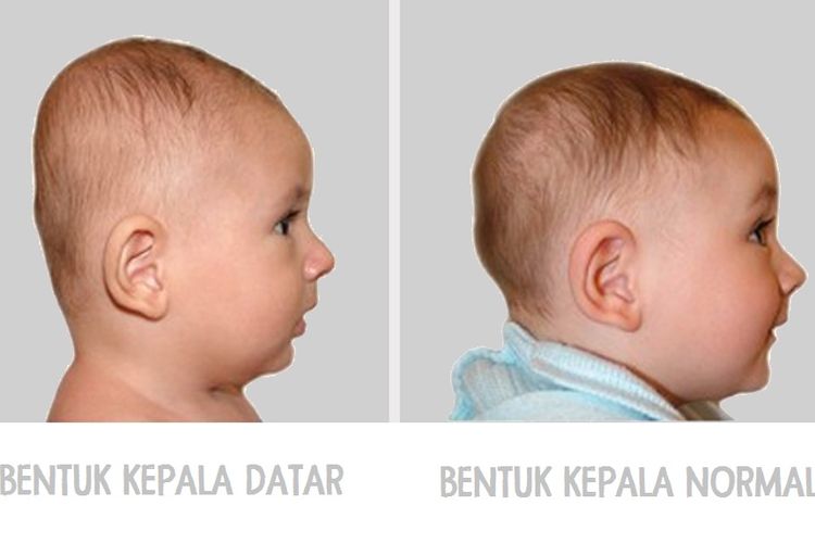Periksa Kepala Bayi Ibu Bila Datar Tumbuh Kembangnya Berisiko Semua Halaman Nakita<script async src=