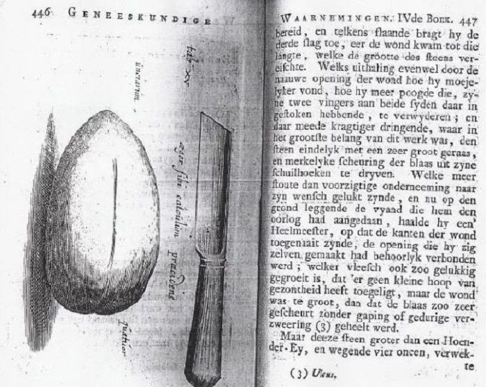 Halaman yang dipindai menunjukkan pisau Jan de Doot dan batu ginjal yang diambil dengan pisau dari ginjalnya sendiri dengan bantuan saudaranya pada abad ke-17.