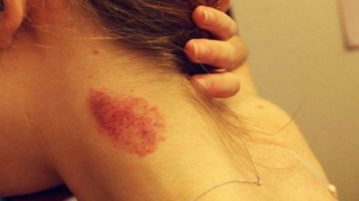 Jangan Asal Cium Dan Mencupang Leher 3 Wanita Salah Satunya Pengantin Baru Meninggal Setelah Mendapatkannya Di Malam Pertama Semua Halaman Grid Health