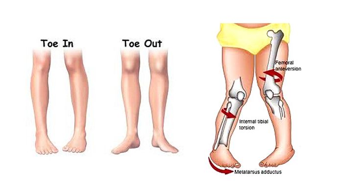 Jangan Sepelekan Ini Risiko Bila Si Kecil Suka Duduk Dengan Posisi W Semua Halaman Nakita