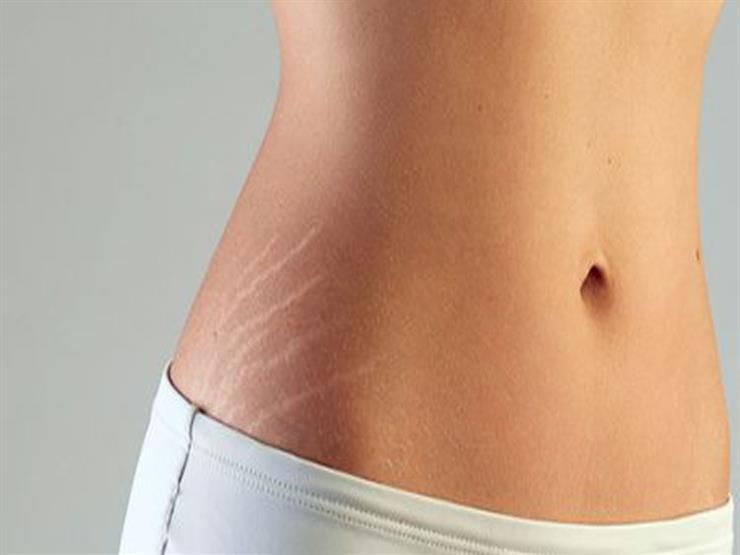 Atasi Stretch Mark Pada Kulit Remaja Milenial Harus Tahu Nih Kepoin Yuk Semua Halaman Grid Id